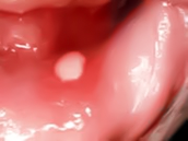 Aftas - Causas & Tratamiento